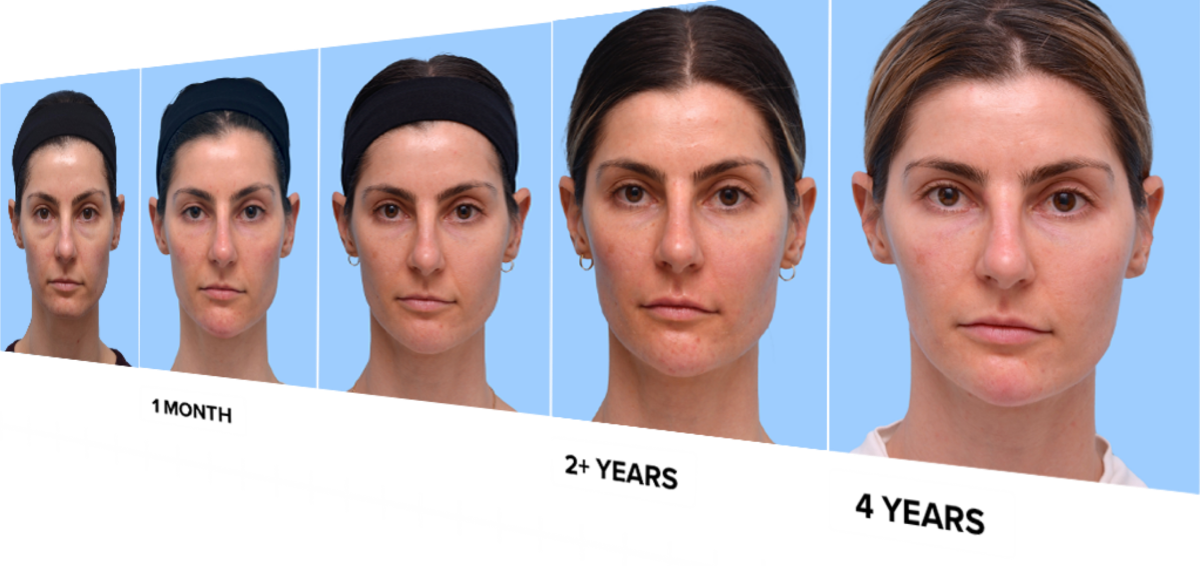 How Long Does Filler Last