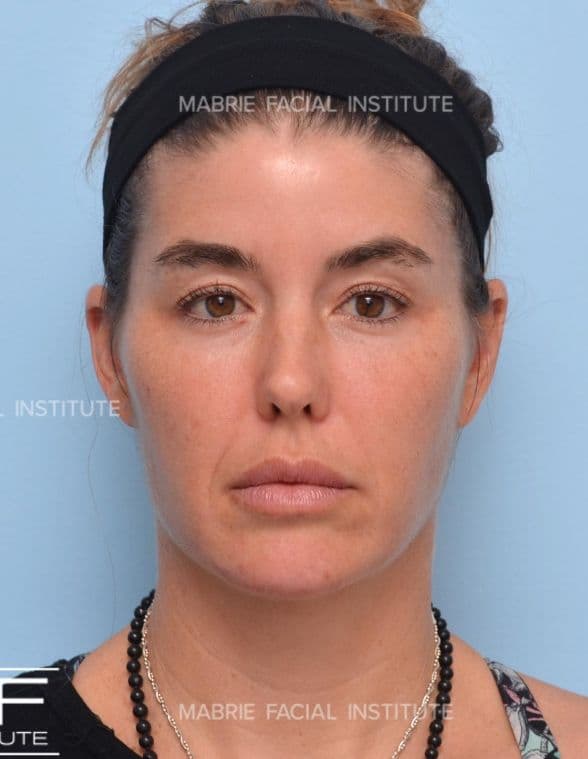 Botox - After
