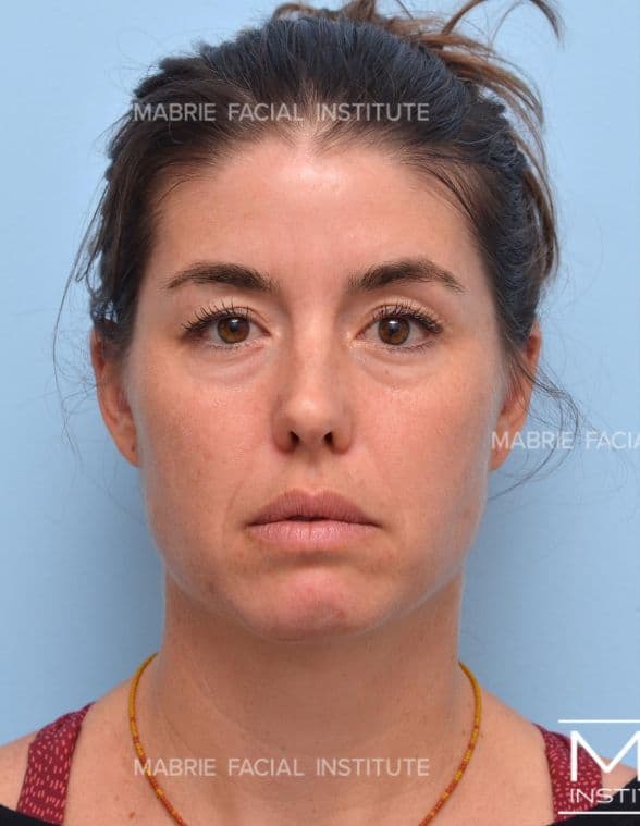Botox - Before
