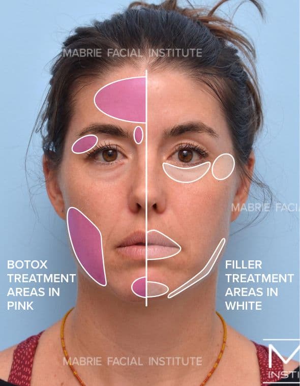 Botox + Fillers