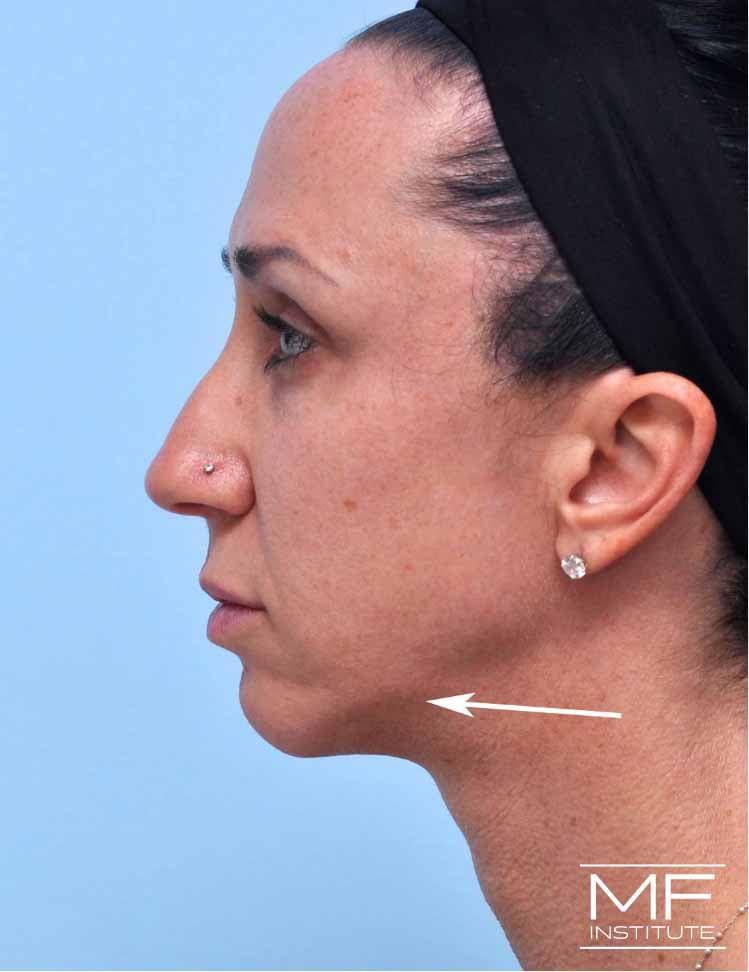 A woman with jawline lumps after first treatment