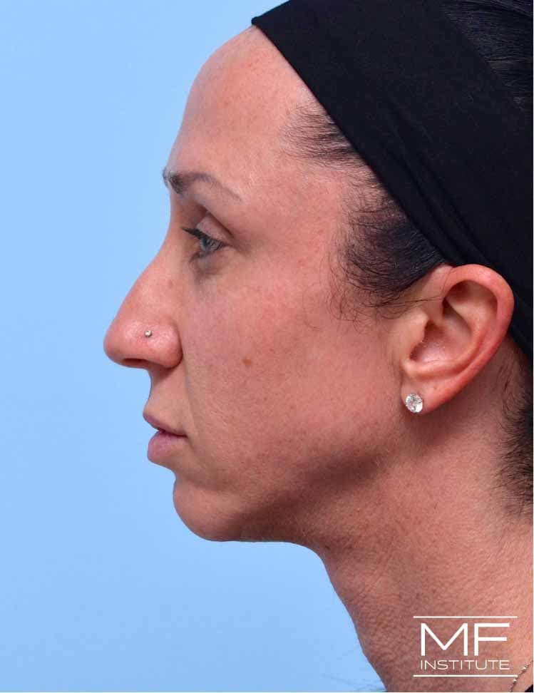 A woman with jawline lumps before treatment