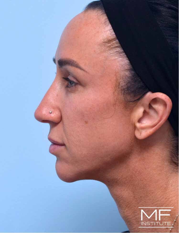 A woman who had jawline lumps after final treatment