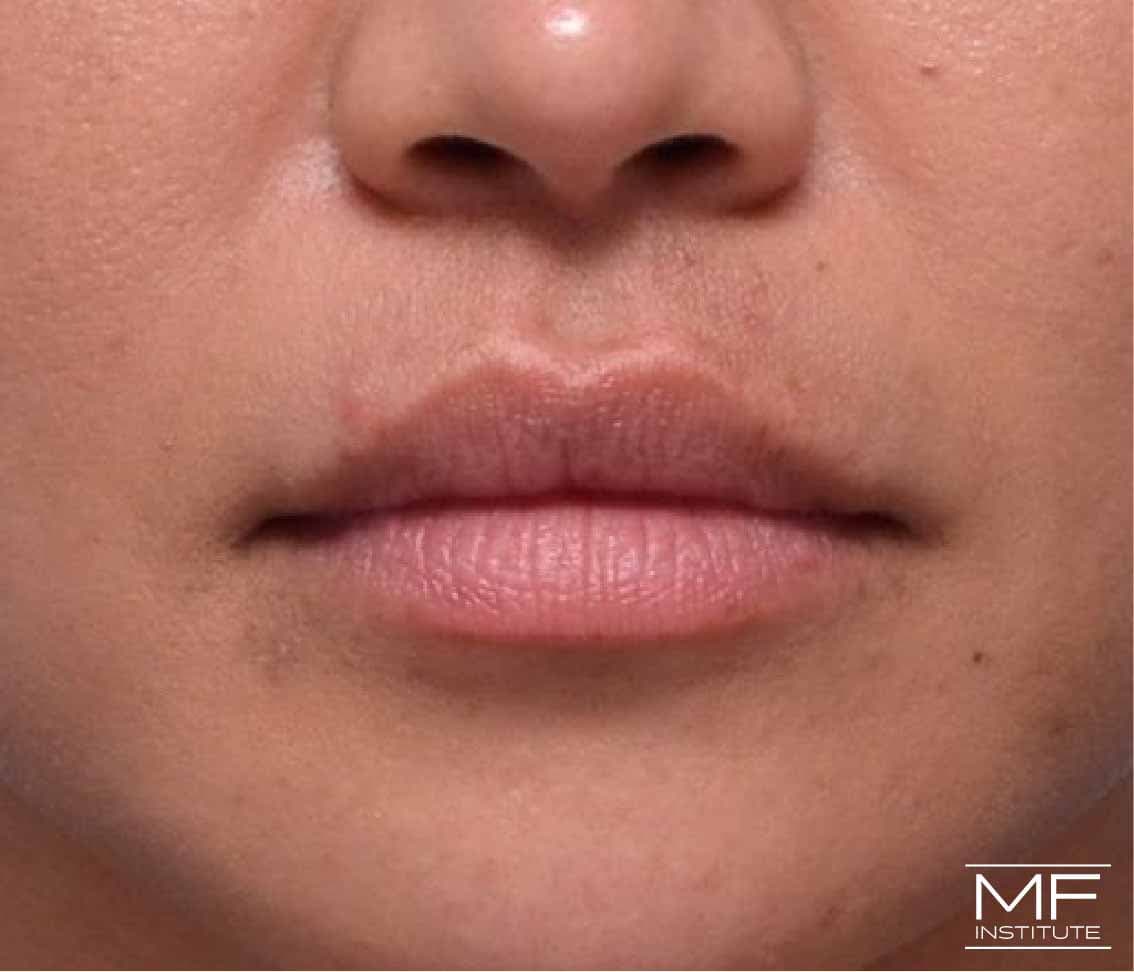 A woman showing no bump after lip filler