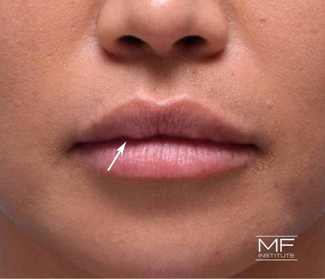 A woman with a small bump after lip filler