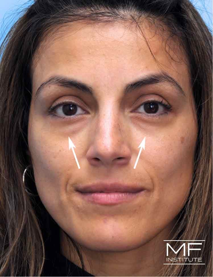 A woman with under eye unevenness after her first treatment