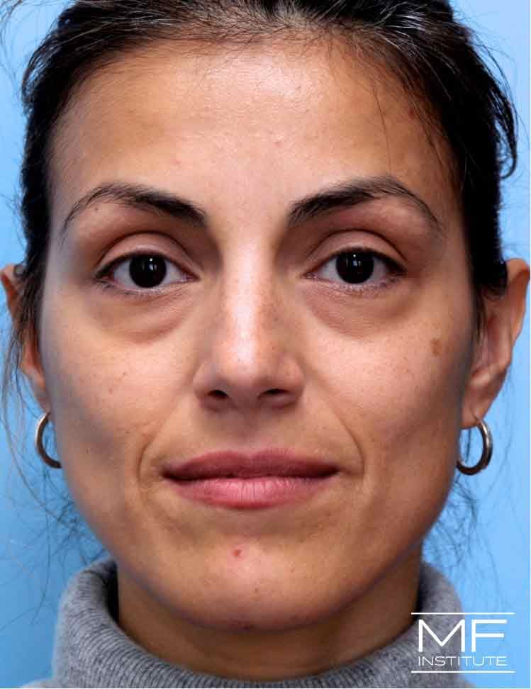 A woman with under eye unevenness before treatment