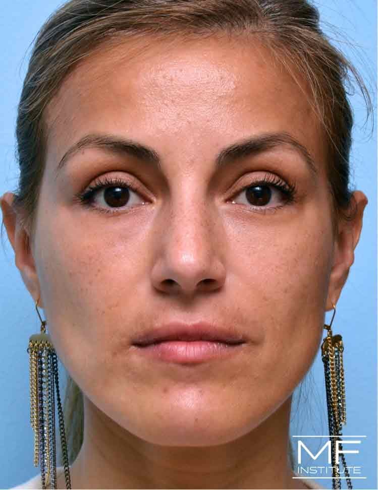 A woman who had under eye unevenness after her final treatment