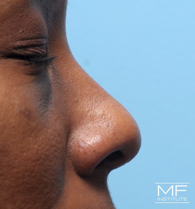 A woman's face before nose filler