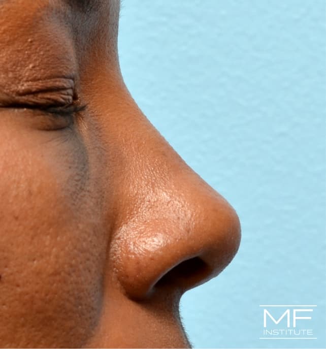 A woman's face immediately following nose filler