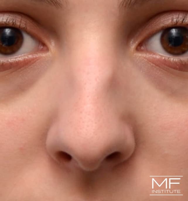 A woman's face before nose filler