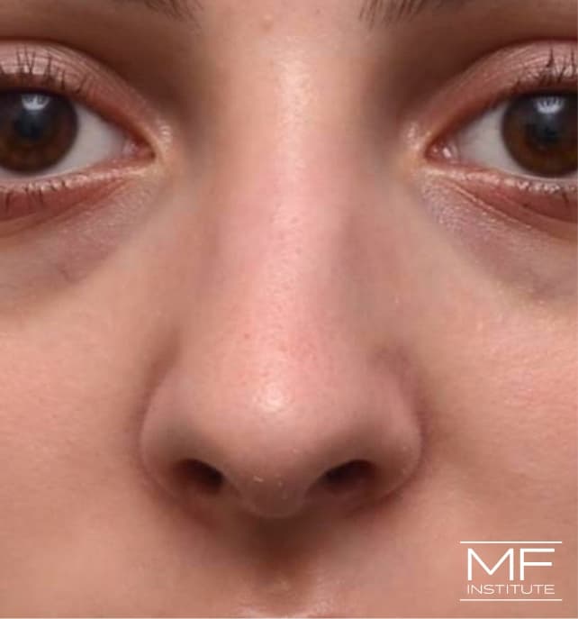 A woman's face immediately following nose filler