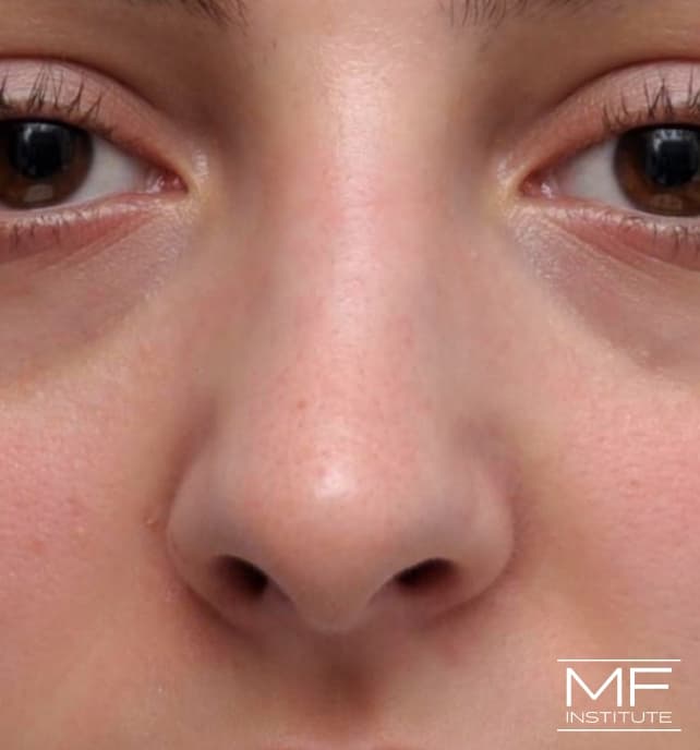 A woman's face a year after nose filler