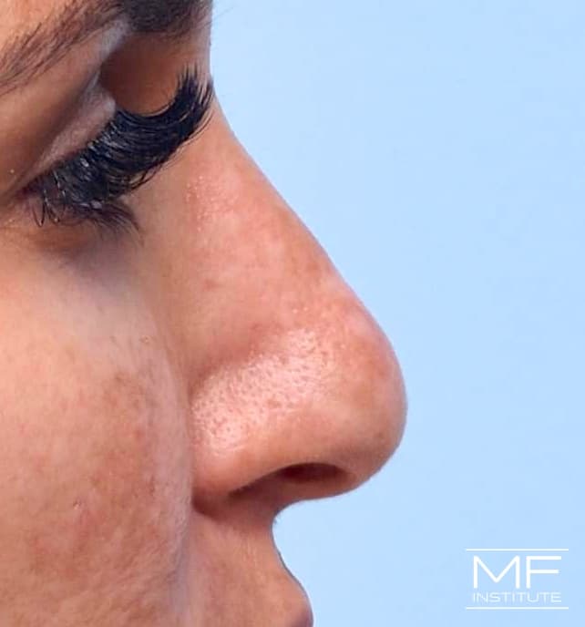 A woman's face before nose filler