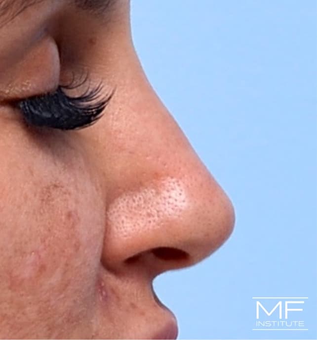 A woman's face immediately following nose filler
