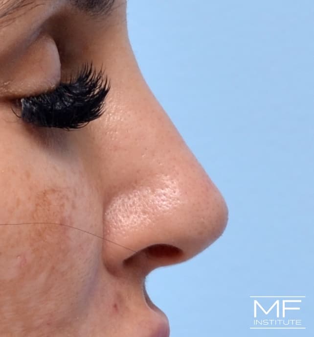 A woman's face one year after after nose filler