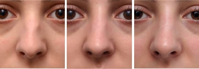 Progression of woman's face before, immediately after, and 1 year after nose filler treatment