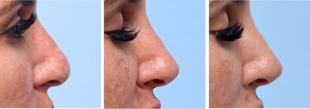 Progression of woman's face before, immediately after, and 1 year after nose filler treatment
