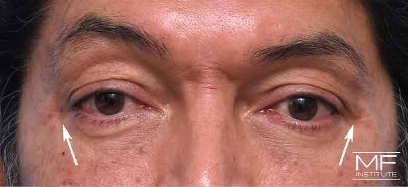 A man's face immediately following botox injections