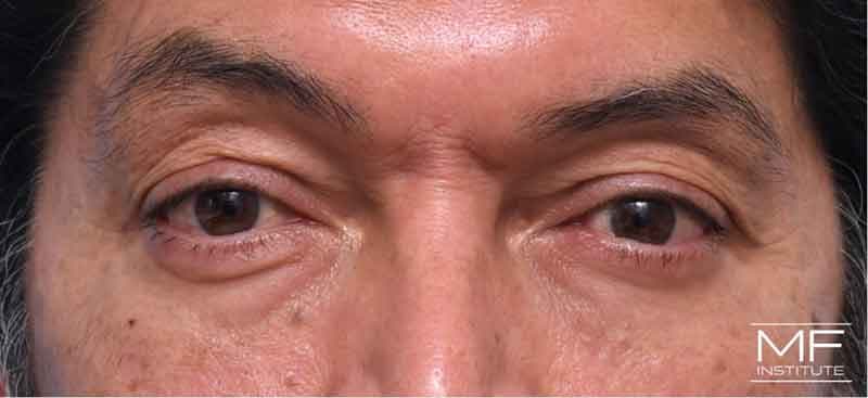 A man's face before botox