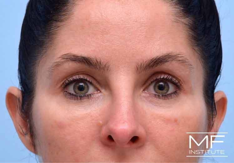 A woman's face three days after under eye treatment