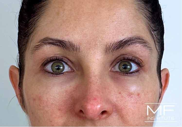 A woman's face one day after under eye treatment