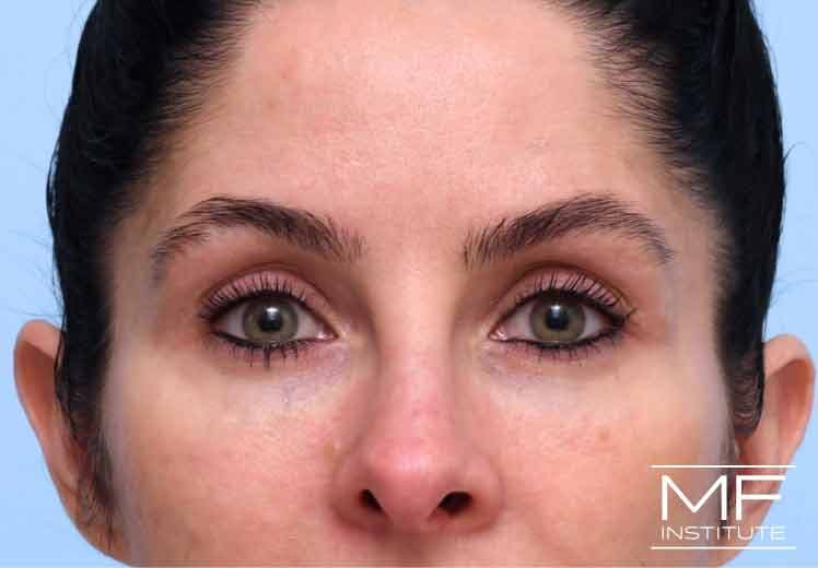 A woman's face three weeks after under eye treatment