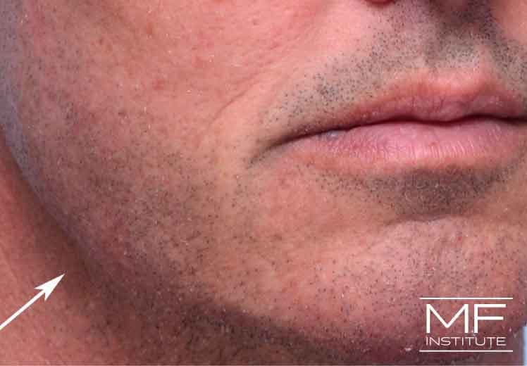 A man's jawline four weeks after treatment, showing most swelling has subsided
