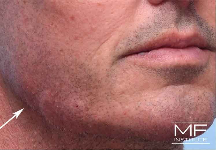 A man's jawline showing swelling immediately following jawline filler treatment