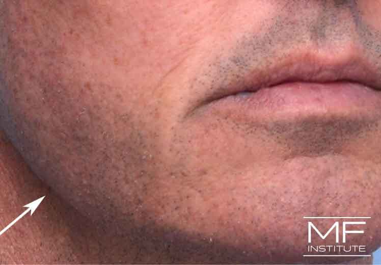 A man's jawline eight weeks after treatment, with no swelling