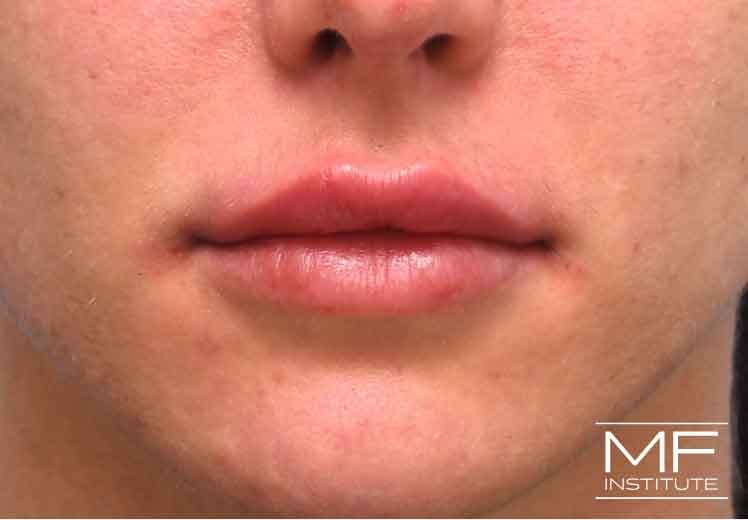 A woman's face immediately following lip filler