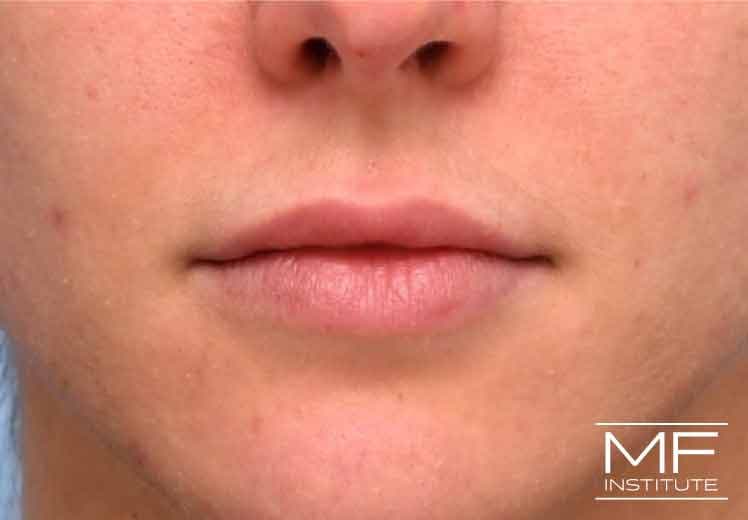 A woman's face before lip filler
