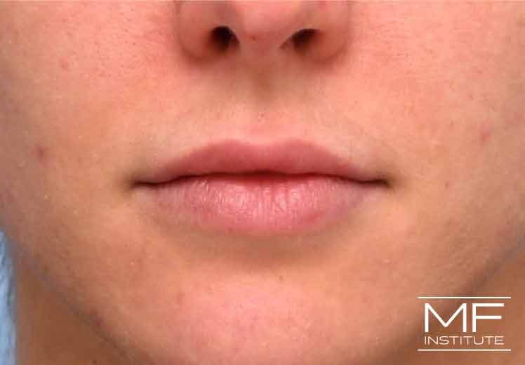 A woman's face before lip filler