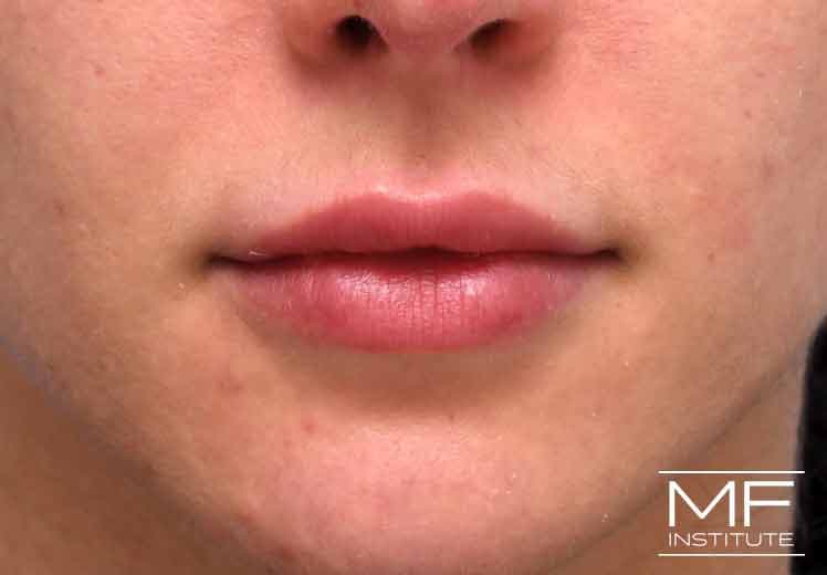 A woman's face four weeks after lip filler