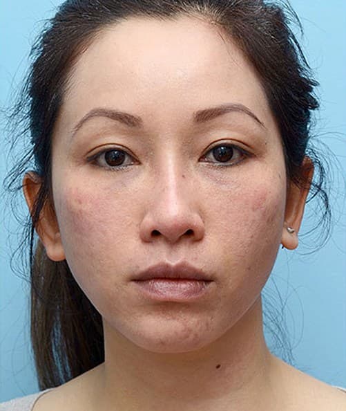 womans face after procedure