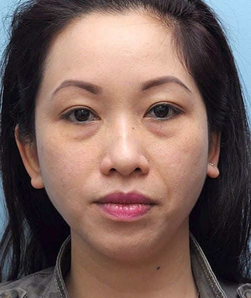woman's face before procedure