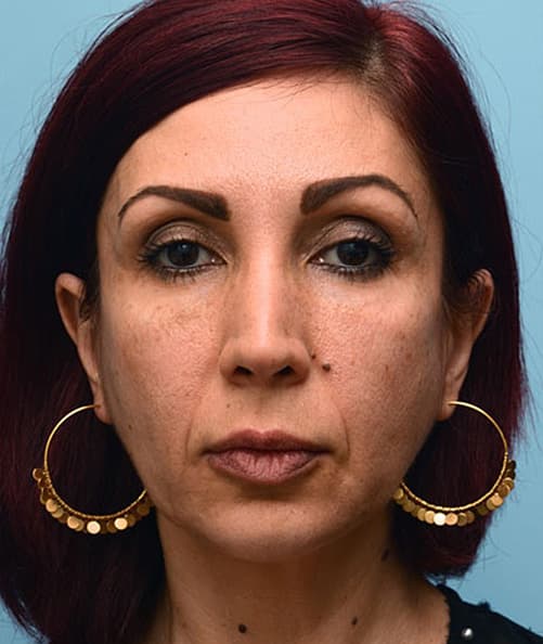 woman's face after procedure