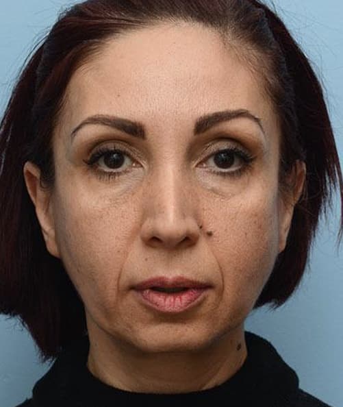 woman's face before procedure