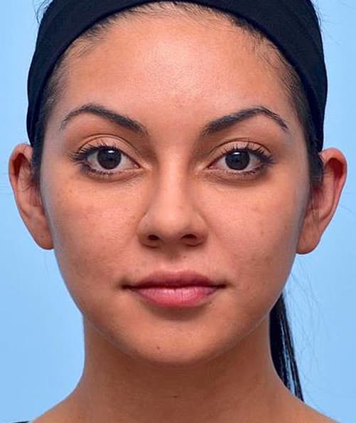 woman's face after procedure