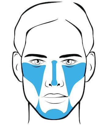 face map of treated areas for non surgical facelift