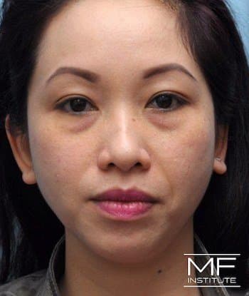 female before full face rejuvenation