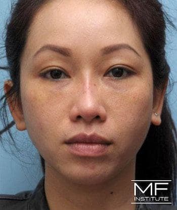 female before full face rejuvenation