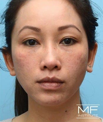 female before full face rejuvenation