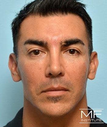 male before full face rejuvenation