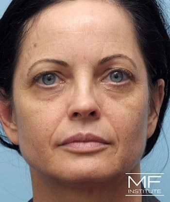 woman before midface rejuvenation