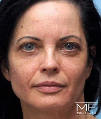 woman before midface rejuvenation