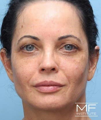 woman before midface rejuvenation