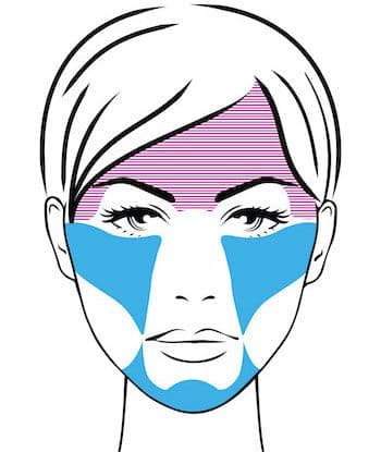 face map of treated areas for midface rejuvenation