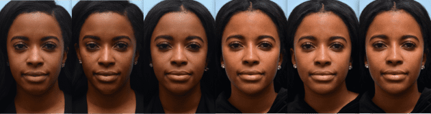 before and after female multiple views of facial contouring