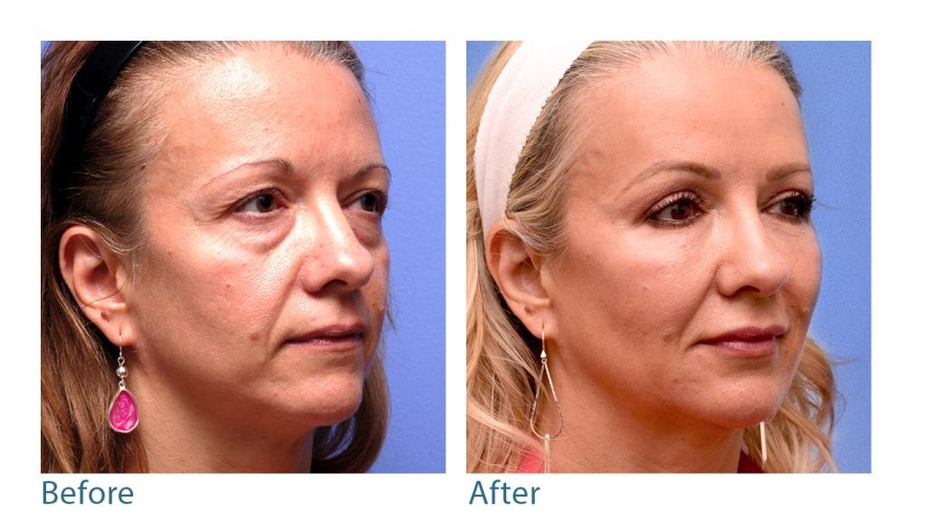 Botox before-and-after in San Francisco.